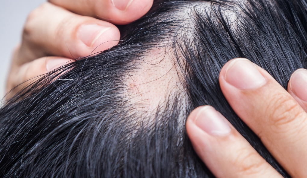 Alopecia Androgenética